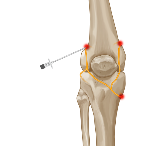 nerve-cooling technique knee replacement surgery