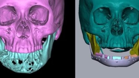 3D-Printed Jaw Implant