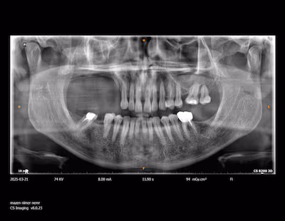 3D-Printed Jaw Implant