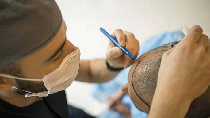 Best Hair Transplant Doctors in UAE