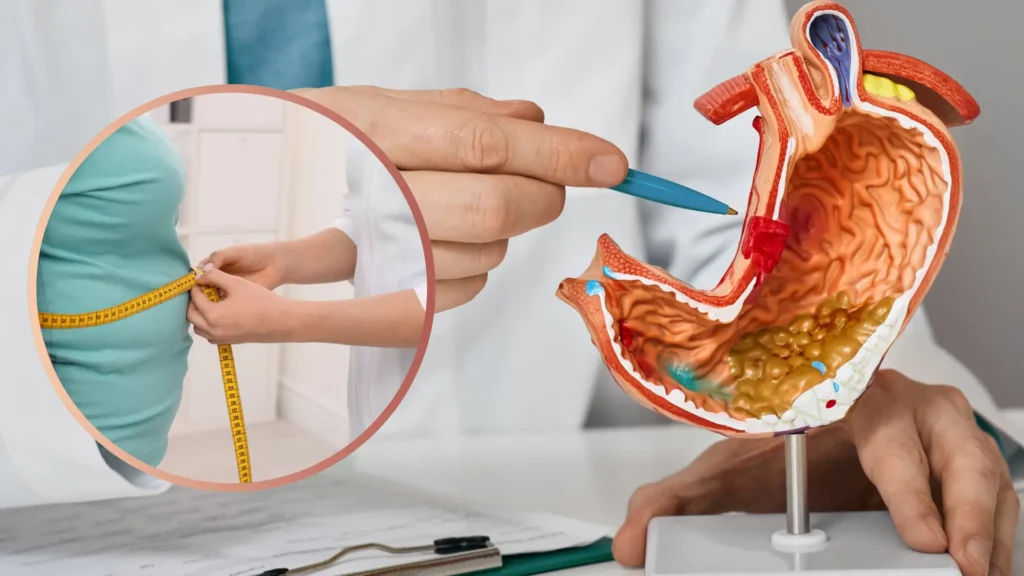 Gastric Sleeve Surgery