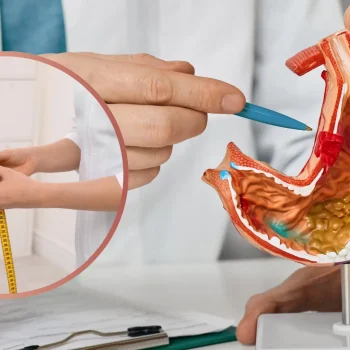 Gastric Sleeve Surgery